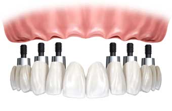 Laboratório de Prótese Dentária Lindo Sorriso - Foto 1